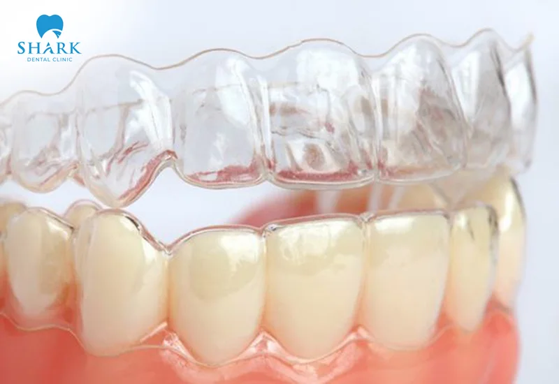Wearing retainers for 6 to 12 months after braces ensures the best results