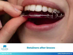 Retainers after braces