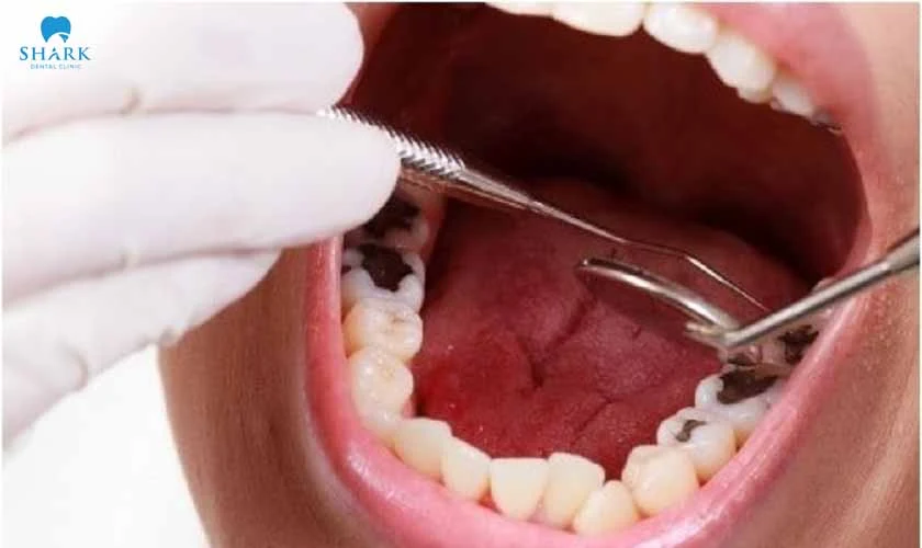 Prolonged and intense pain after a dental filling should be examined by a dentist