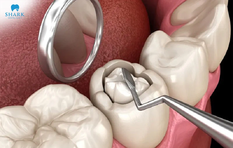 A cracked filling or the use of unsafe filling materials are common causes of tooth pain