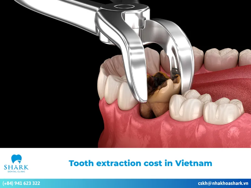How much does tooth extraction cost in Vietnam?