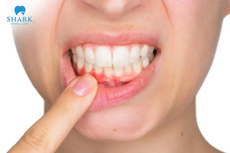 There are various reasons why a dental filling may fall out