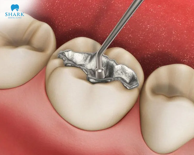 A broken filling can affect both your oral health and daily activities