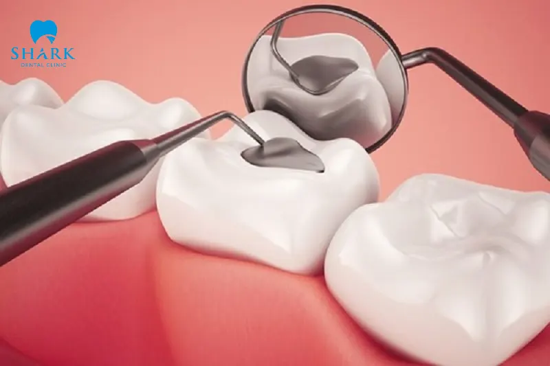 Many customers choose to have their teeth filled in Vietnam because of the low cost and the ability to combine it with travel