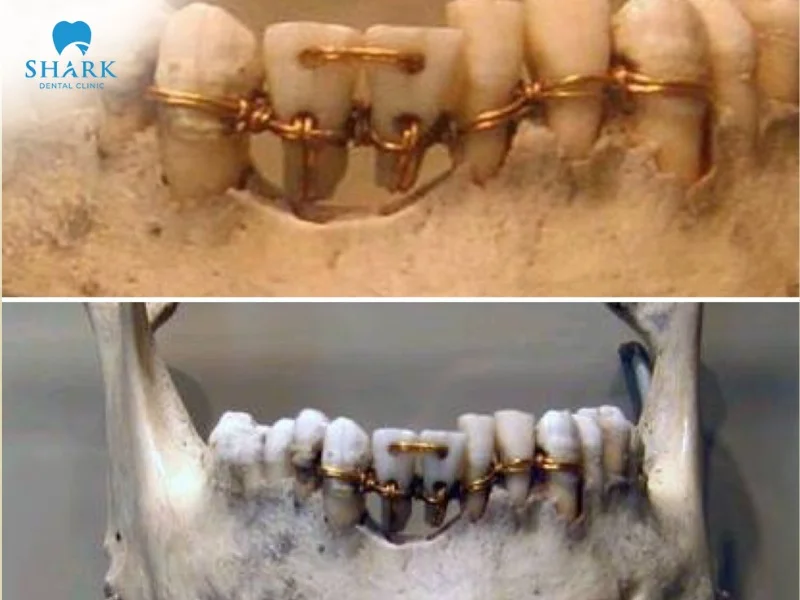 Between 26 – 50 BC, Aulus Cornelius Celsus recorded the use of force to adjust the position of teeth