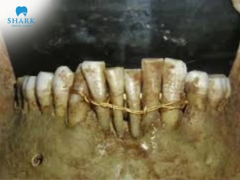 In ancient Greece, appliances were already used to align crooked teeth