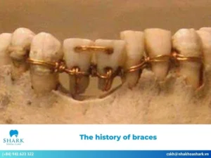 The history of braces