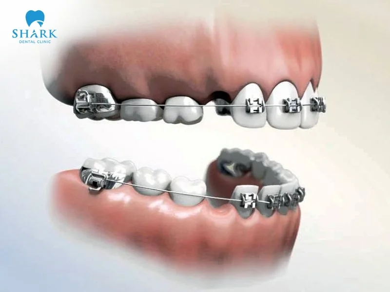 The modern method of orthodontics was invented around 1728