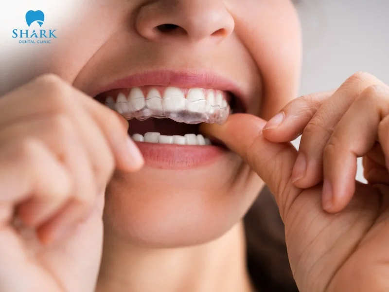 Clear aligners were developed by a Stanford University student in 1997