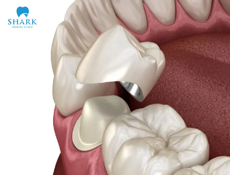 Porcelain fused to metal crowns are applied for molar teeth cases that require high durability.