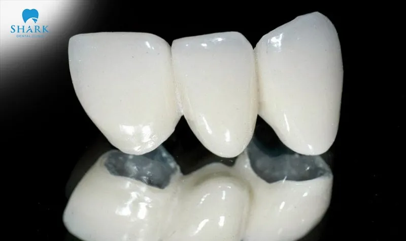 Titanium crowns offer high durability and quickly adapt biologically within the oral cavity.