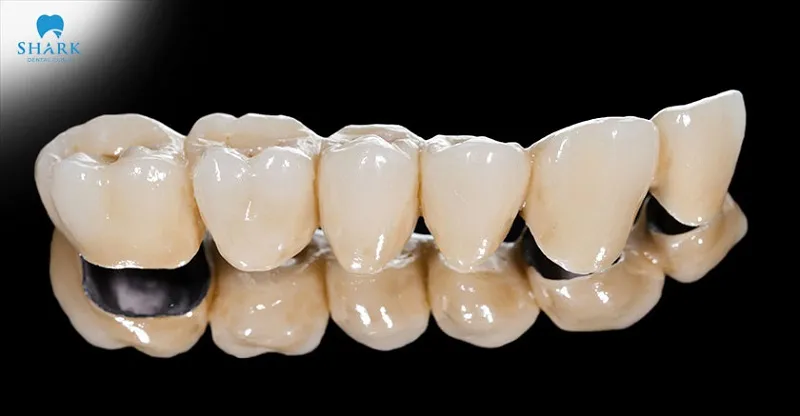 Porcelain fused to metal crowns offer long-lasting durability over time.