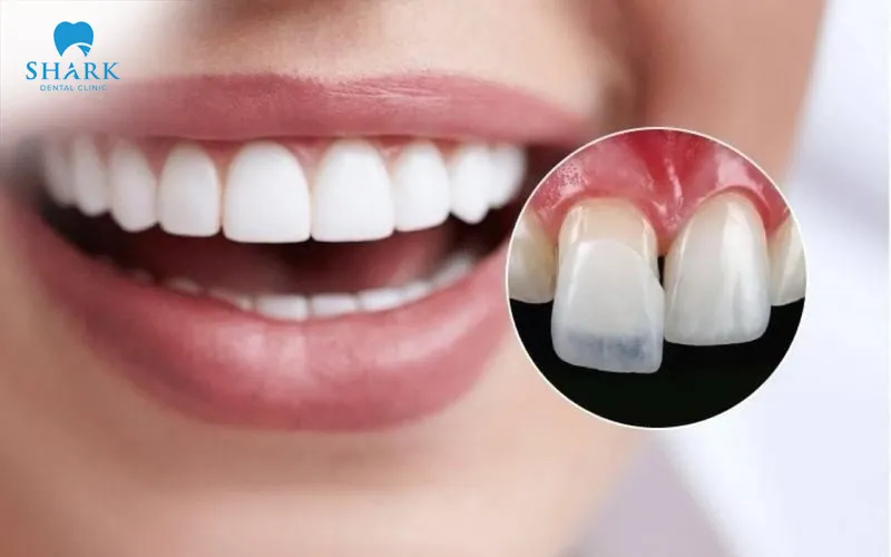 Can you get veneers with missing teeth?