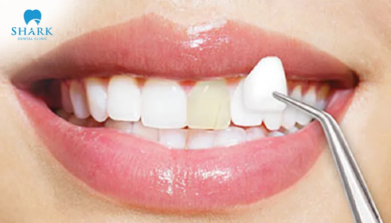 Veneer application only improves the surface of the tooth and cannot restore missing teeth