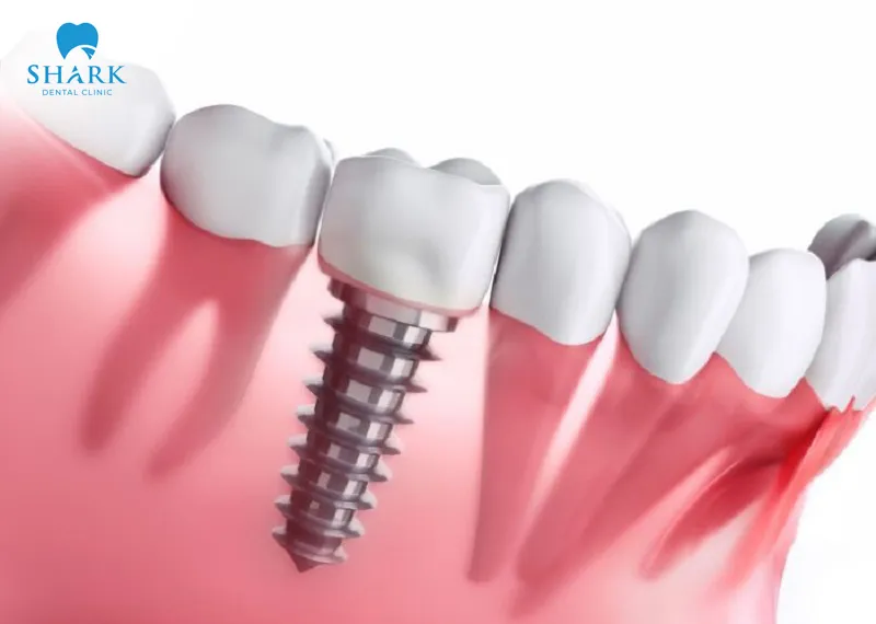 For missing teeth, dental implants should be considered for restoration