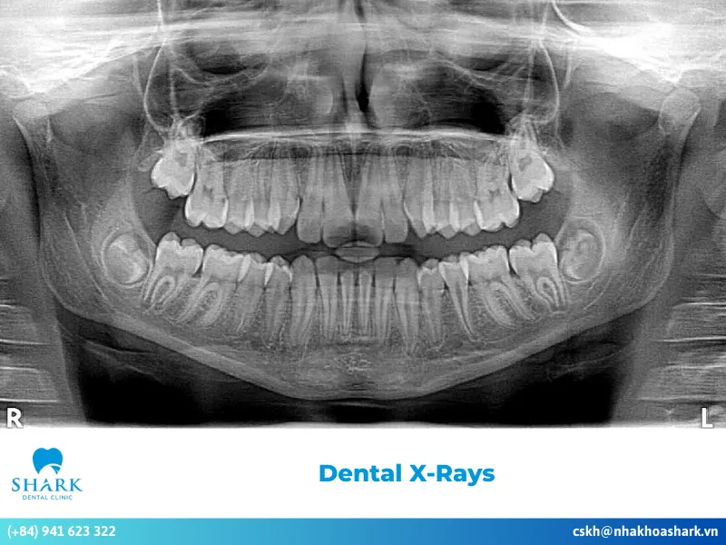 What are dental X-Rays?