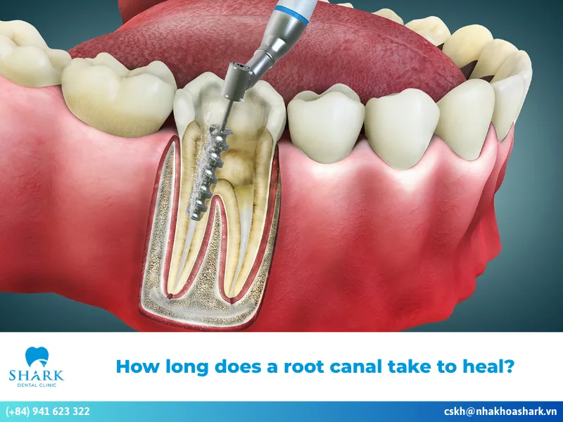 How long does a root canal take to heal?