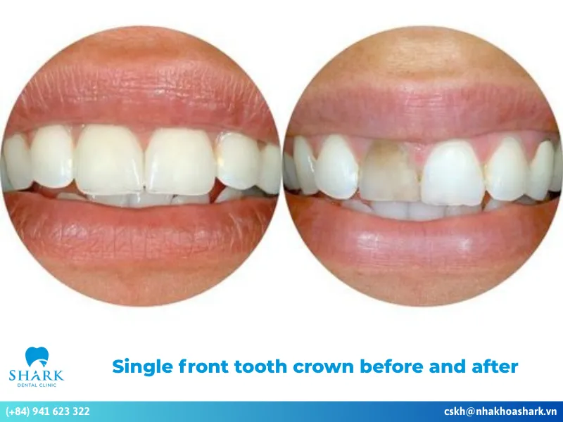 Single front tooth crown before and after
