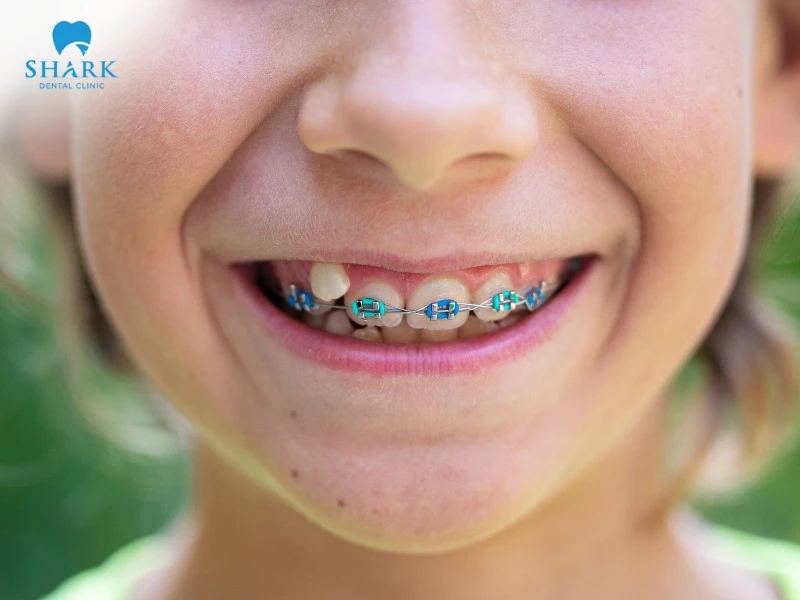 The most suitable age for braces is between 12 and 16 years old