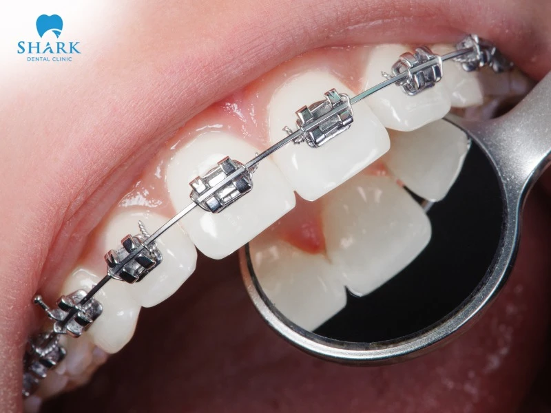 Children need braces if their teeth are misaligned, causing difficulties in chewing or communication