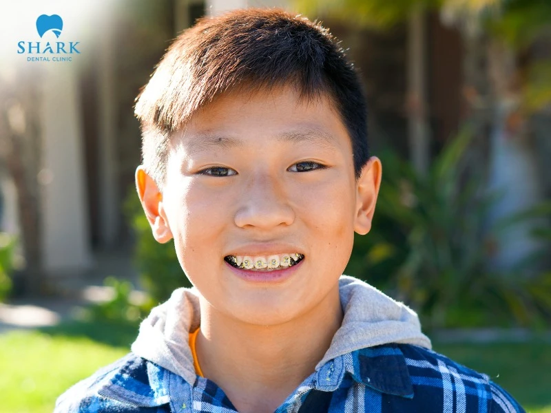 Getting braces early for children helps improve aesthetics and prevent oral diseases