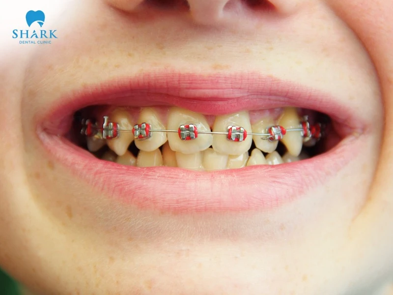 Children usually need to wear braces for about 6 months to 1 year