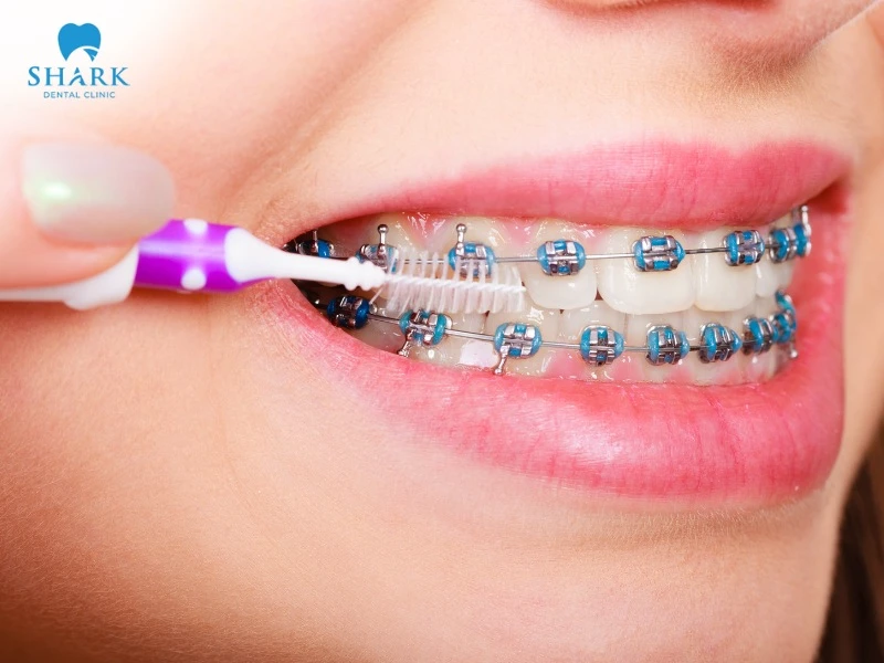 You should choose a toothbrush for braces from a trusted brand and always clean it properly after each use
