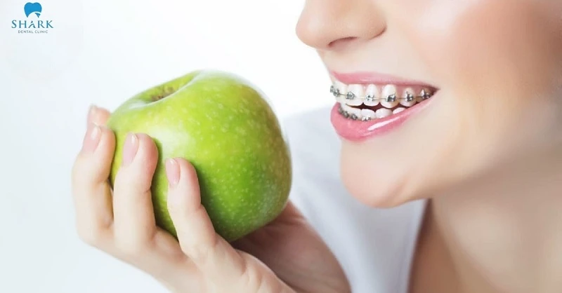 Can you eat apples with braces? The answer is yes