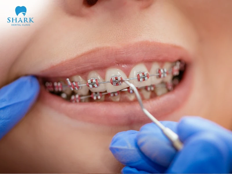 Eating hard chips may cause brackets to loosen or fall off, which can prolong treatment time and affect the results