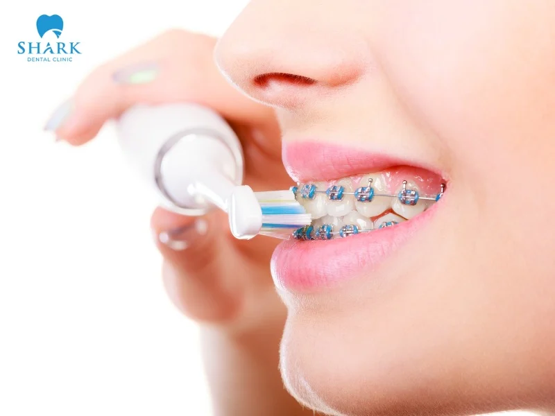 After eating pizza, those with braces need to thoroughly clean their mouth to remove any leftover pizza debris