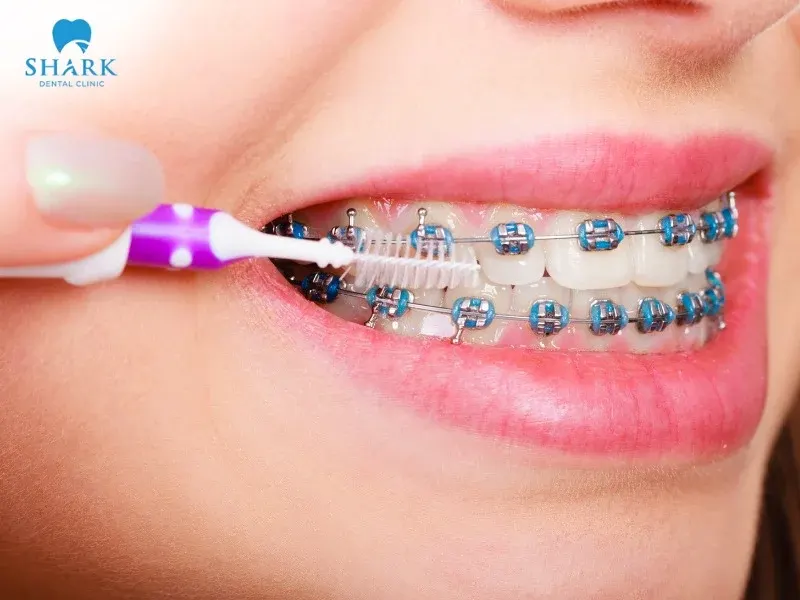 After eating steak, you should pay close attention to oral hygiene to minimize the risk of tooth decay