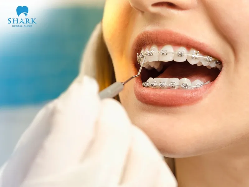 Pregnant women are advised not to get braces because this is a sensitive period with many bodily changes