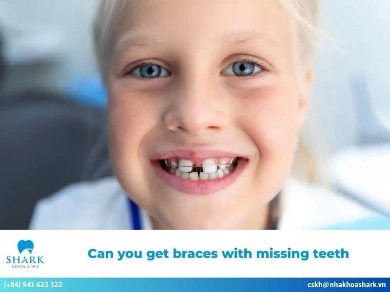 Can you get braces with missing teeth