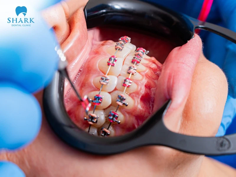 You can still get braces with missing teeth in certain cases