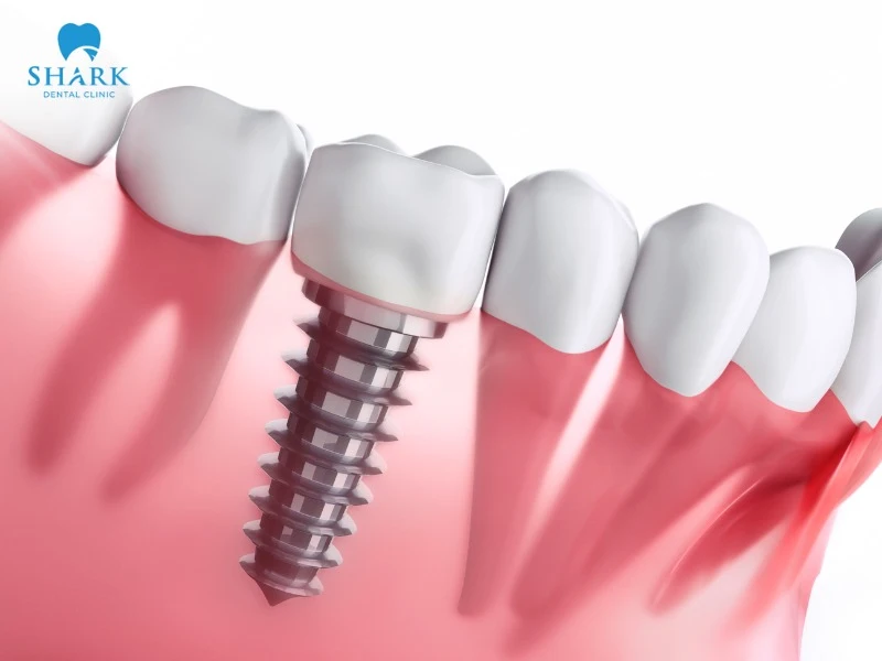 Dental implants can completely replace missing teeth, restoring a strong, healthy, and confident smile