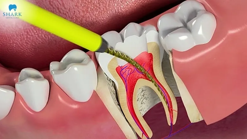 How long does a root canal take to heal?