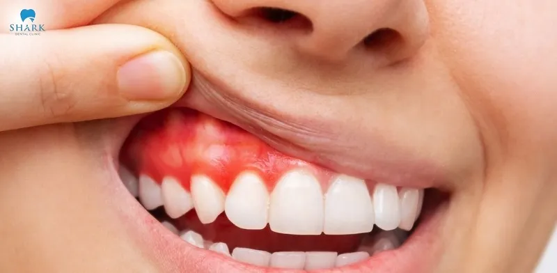 Recovery time will be longer if the patient also has other oral conditions such as periodontitis or periapical inflammation