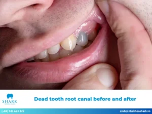 Dead tooth root canal before and after