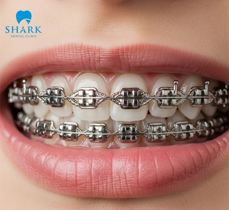 This method provides greater comfort for patients throughout the orthodontic process