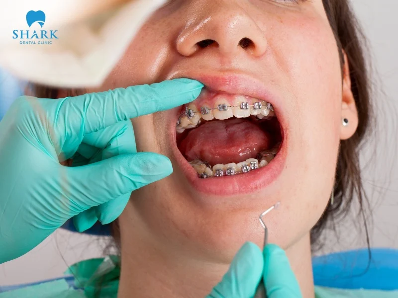 The procedure for diamond braces is similar to other traditional orthodontic methods