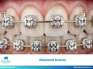 Diamond braces