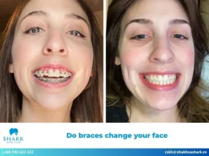 Do braces change your face