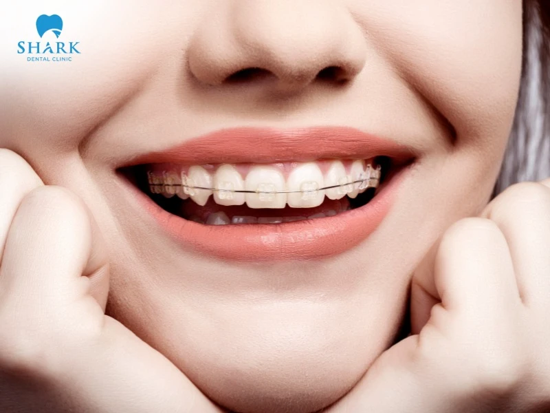 Orthodontic treatment helps create a bright, youthful, and radiant smile, boosting confidence in daily communication