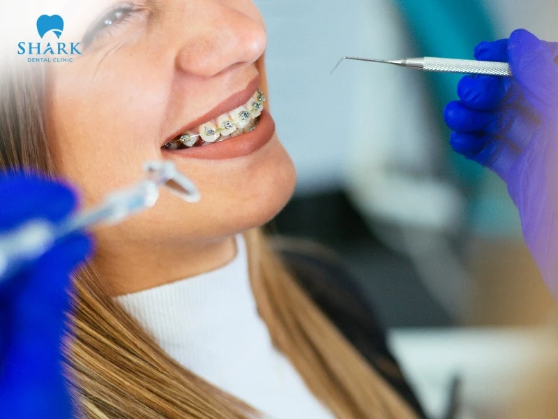 Braces not only bring a confident smile but also help keep your teeth strong, straight, and more attractive