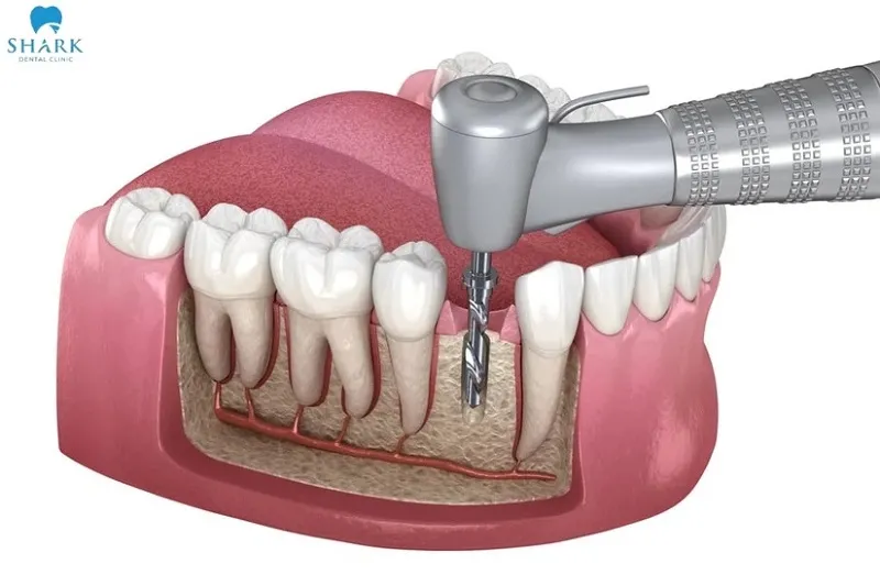 Dead tooth root canal treatment is a dental procedure performed to remove all damaged, infected, or necrotic pulp tissue inside the tooth