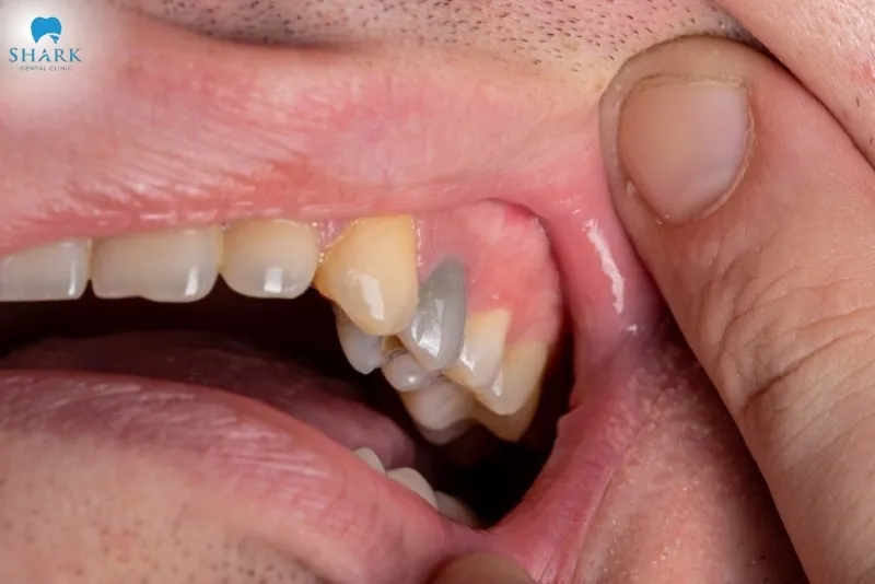 When the dental pulp dies, the tooth will change color to gray, dark brown, or dark yellow