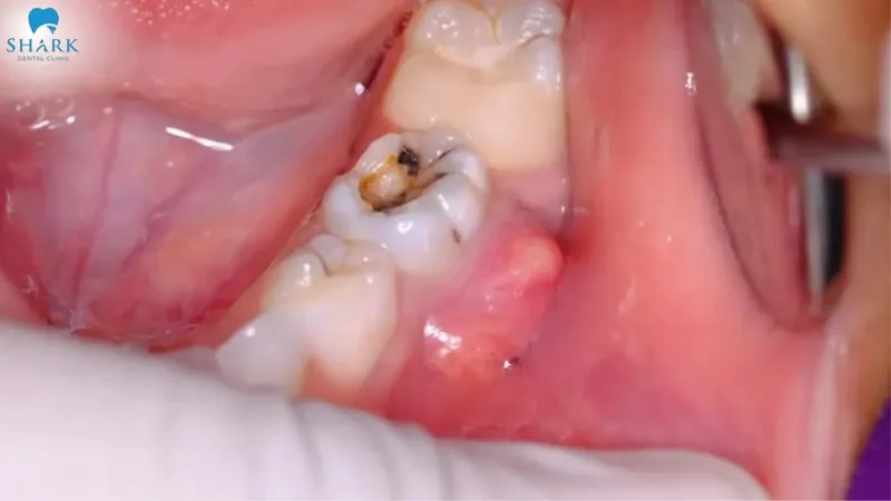 Before root canal treatment, pus and abscesses may appear in the area affected by pulp necrosis