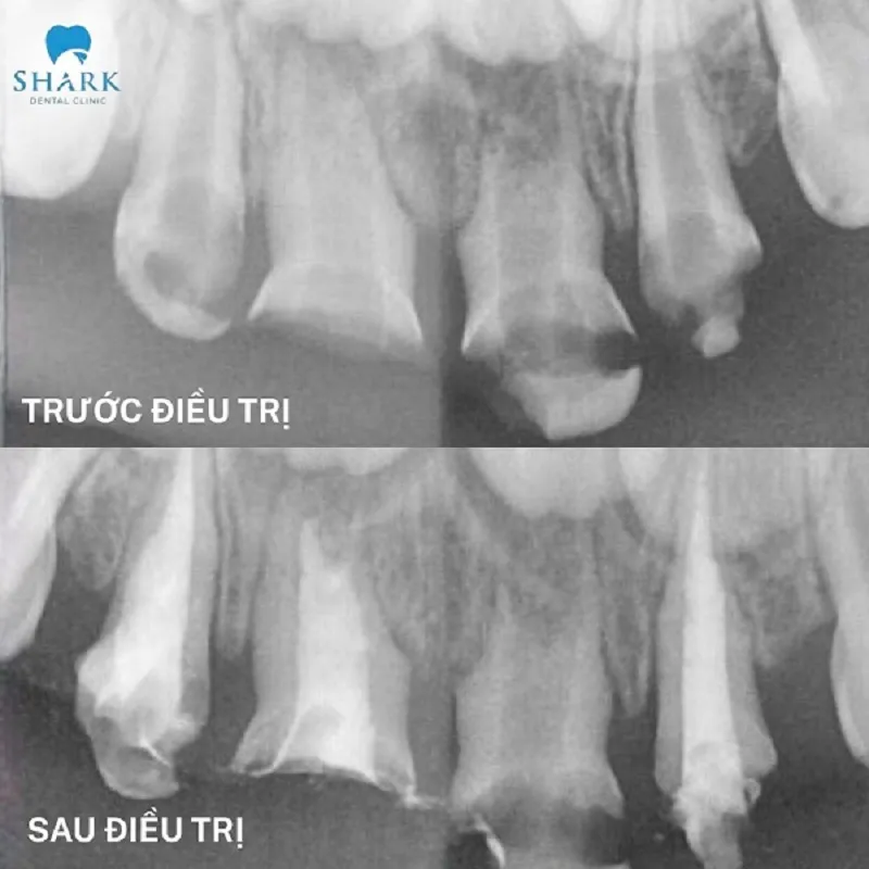 Dead tooth root canal before and after shown through X-ray images