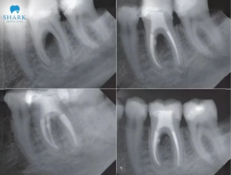 X-ray images show that after treatment, the root canal has been shaped and thoroughly sealed, helping restore the tooth’s function