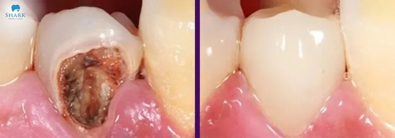 Actual images of dead tooth root canal before and after treatment